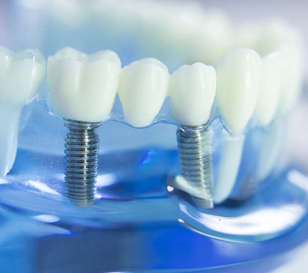 El Monte Dental Implants