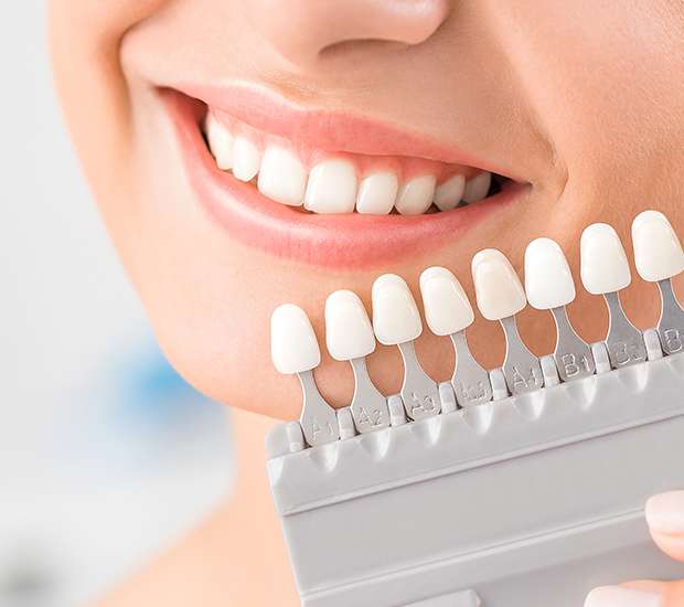 El Monte Dental Veneers and Dental Laminates