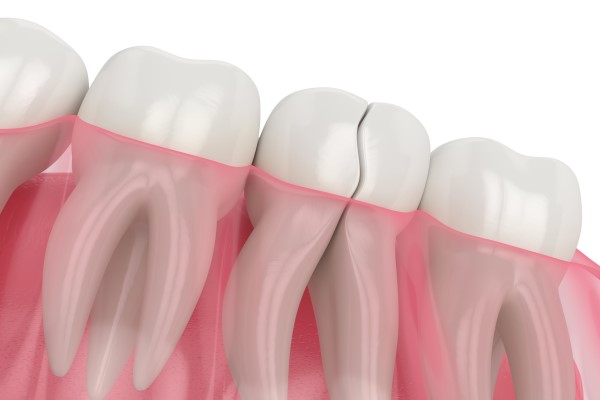 Restorative Dentistry Options For A Broken Tooth