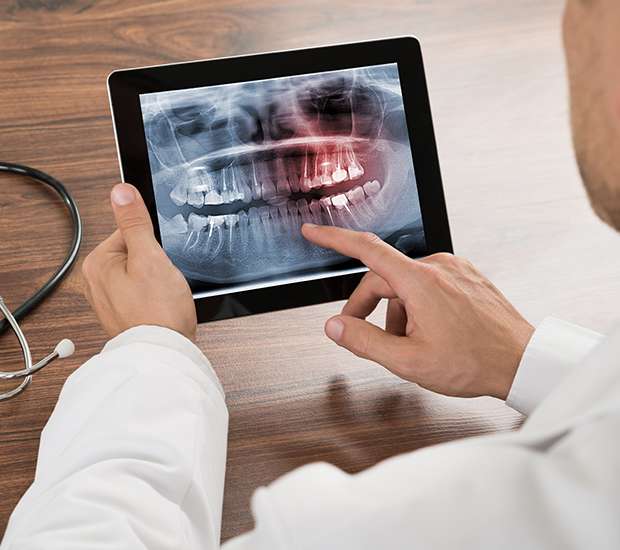 El Monte Types of Dental Root Fractures